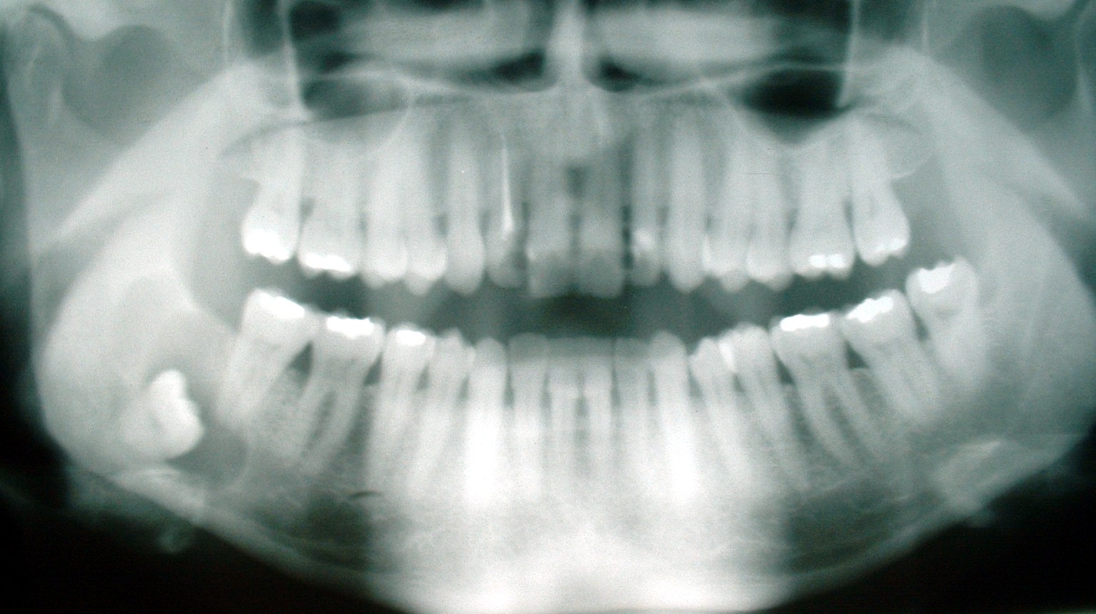 wisdomteethxray Mt Eliza Dental Centre